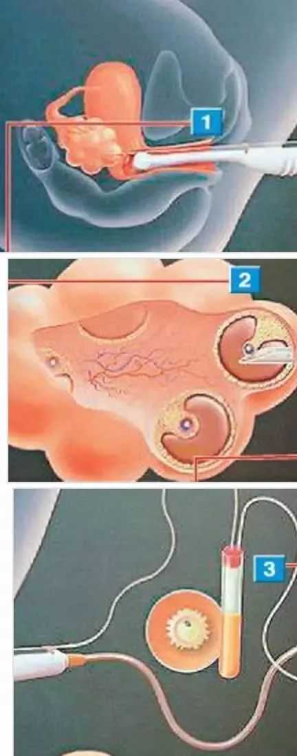 北京供卵交流群真实体验：患者经验与避坑指南